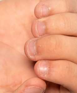 cuanto tardan en crecer las uñas mordidas