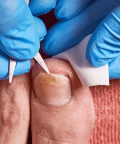 como prevenir hongos en las uñas de los pies