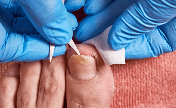 como prevenir hongos en las uñas de los pies